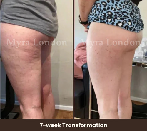 3D Anti-Cellulite Leggings
